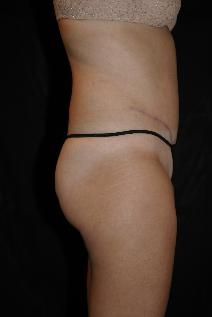 Tummy Tuck After Photo by James Sheridan, MD; Austin, TX - Case 7506