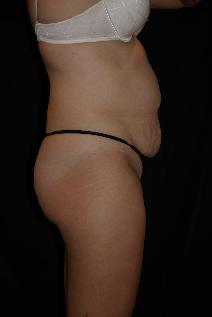 Tummy Tuck Before Photo by James Sheridan, MD; Austin, TX - Case 7506