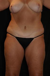 Tummy Tuck After Photo by James Sheridan, MD; Austin, TX - Case 7509