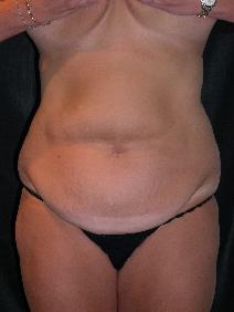 Tummy Tuck Before Photo by James Sheridan, MD; Austin, TX - Case 7509