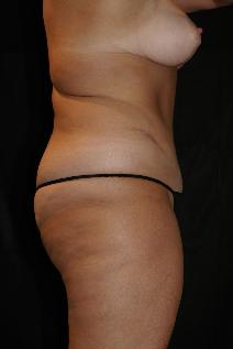 Tummy Tuck After Photo by James Sheridan, MD; Austin, TX - Case 7509
