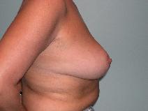 Breast Reduction After Photo by James Sheridan, MD; Austin, TX - Case 7512