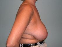 Breast Reduction Before Photo by James Sheridan, MD; Austin, TX - Case 7512