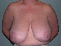 Breast Reduction Before Photo by James Sheridan, MD; Austin, TX - Case 7514