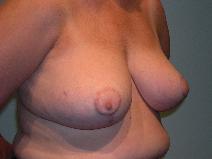 Breast Reduction After Photo by James Sheridan, MD; Austin, TX - Case 7514