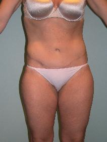 Tummy Tuck After Photo by James Sheridan, MD; Austin, TX - Case 7528