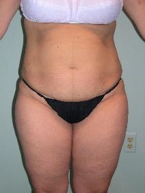 Tummy Tuck Before Photo by James Sheridan, MD; Austin, TX - Case 7528
