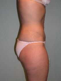 Tummy Tuck After Photo by James Sheridan, MD; Austin, TX - Case 7528