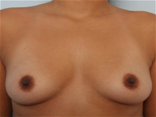 Breast Augmentation Before Photo by Paul Vitenas, Jr., MD; Houston, TX - Case 25986