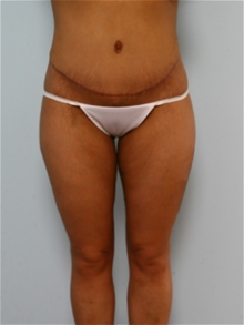 Body Contouring After Photo by Paul Vitenas, Jr., MD; Houston, TX - Case 25987