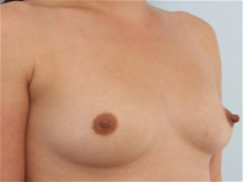 Breast Augmentation Before Photo by Paul Vitenas, Jr., MD; Houston, TX - Case 25988