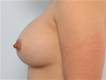 Breast Augmentation After Photo by Paul Vitenas, Jr., MD; Houston, TX - Case 25988
