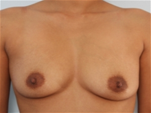 Breast Augmentation Before Photo by Paul Vitenas, Jr., MD; Houston, TX - Case 25989