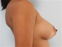 Breast Augmentation After Photo by Paul Vitenas, Jr., MD; Houston, TX - Case 25989