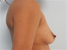 Breast Augmentation Before Photo by Paul Vitenas, Jr., MD; Houston, TX - Case 25989