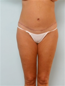 Body Contouring After Photo by Paul Vitenas, Jr., MD; Houston, TX - Case 25990