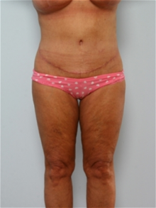 Body Contouring After Photo by Paul Vitenas, Jr., MD; Houston, TX - Case 25991