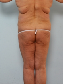 Body Contouring Before Photo by Paul Vitenas, Jr., MD; Houston, TX - Case 25991