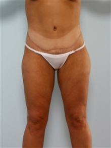 Body Contouring After Photo by Paul Vitenas, Jr., MD; Houston, TX - Case 25992