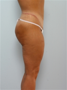 Body Contouring After Photo by Paul Vitenas, Jr., MD; Houston, TX - Case 25992