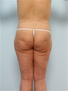 Body Contouring After Photo by Paul Vitenas, Jr., MD; Houston, TX - Case 25992