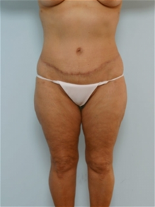 Body Contouring After Photo by Paul Vitenas, Jr., MD; Houston, TX - Case 25993