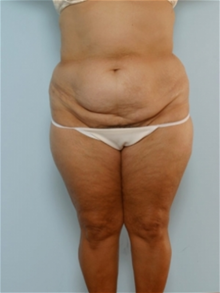 Body Contouring Before Photo by Paul Vitenas, Jr., MD; Houston, TX - Case 25993