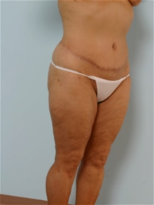 Body Contouring After Photo by Paul Vitenas, Jr., MD; Houston, TX - Case 25993