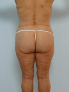 Body Contouring After Photo by Paul Vitenas, Jr., MD; Houston, TX - Case 25993