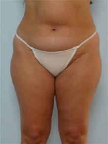Liposuction Before Photo by Paul Vitenas, Jr., MD; Houston, TX - Case 25994