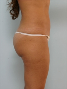 Liposuction After Photo by Paul Vitenas, Jr., MD; Houston, TX - Case 25994