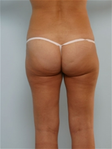Liposuction After Photo by Paul Vitenas, Jr., MD; Houston, TX - Case 25994