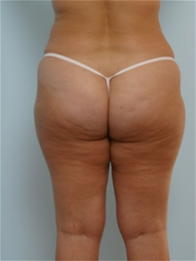 Liposuction Before Photo by Paul Vitenas, Jr., MD; Houston, TX - Case 25994