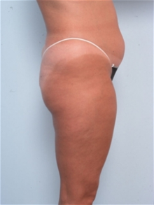 Liposuction Before Photo by Paul Vitenas, Jr., MD; Houston, TX - Case 25995