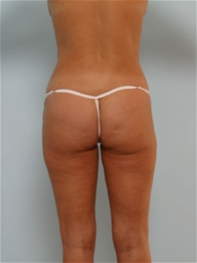 Liposuction After Photo by Paul Vitenas, Jr., MD; Houston, TX - Case 25995