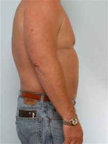 Liposuction After Photo by Paul Vitenas, Jr., MD; Houston, TX - Case 25996