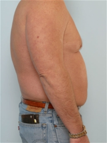 Liposuction Before Photo by Paul Vitenas, Jr., MD; Houston, TX - Case 25996