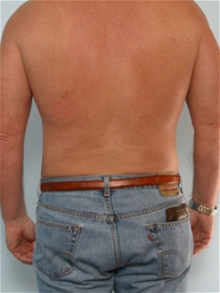 Liposuction After Photo by Paul Vitenas, Jr., MD; Houston, TX - Case 25996