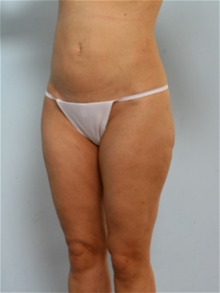 Liposuction After Photo by Paul Vitenas, Jr., MD; Houston, TX - Case 25997