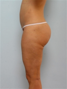 Liposuction After Photo by Paul Vitenas, Jr., MD; Houston, TX - Case 25997