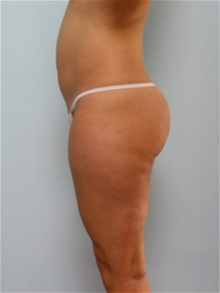 Liposuction Before Photo by Paul Vitenas, Jr., MD; Houston, TX - Case 25997