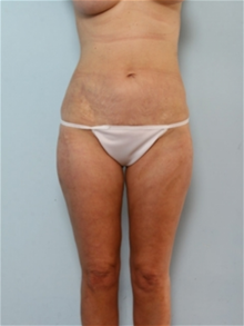 Liposuction After Photo by Paul Vitenas, Jr., MD; Houston, TX - Case 25999