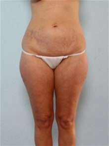 Liposuction Before Photo by Paul Vitenas, Jr., MD; Houston, TX - Case 25999