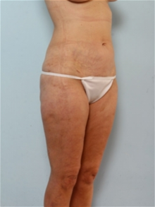 Liposuction After Photo by Paul Vitenas, Jr., MD; Houston, TX - Case 25999