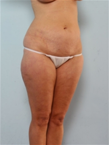 Liposuction Before Photo by Paul Vitenas, Jr., MD; Houston, TX - Case 25999