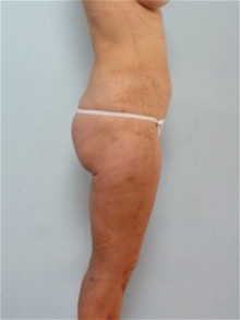 Liposuction After Photo by Paul Vitenas, Jr., MD; Houston, TX - Case 25999