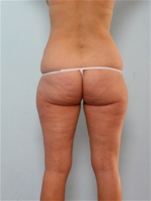 Liposuction Before Photo by Paul Vitenas, Jr., MD; Houston, TX - Case 25999