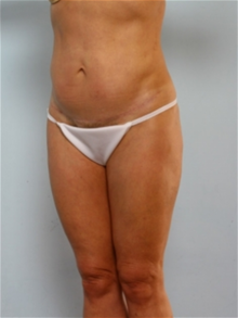 Tummy Tuck After Photo by Paul Vitenas, Jr., MD; Houston, TX - Case 26001