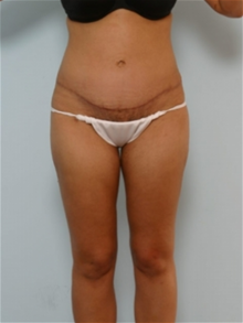 Tummy Tuck After Photo by Paul Vitenas, Jr., MD; Houston, TX - Case 26002