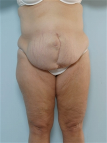 Tummy Tuck Before Photo by Paul Vitenas, Jr., MD; Houston, TX - Case 26003